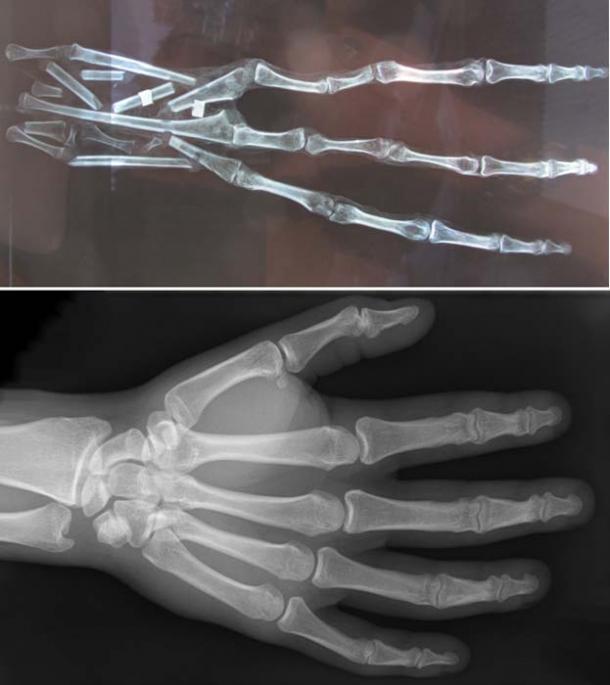 Top: рентгеновский снимок 3-пальцевой руки, показывающий 6 костей в каждом пальце. Кредит: Brien Foerster / Скрытые туры инков. Снизу: рентген человеческой руки, показывающий по 3 кости в каждом пальце.